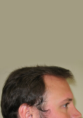 hair transplant photos