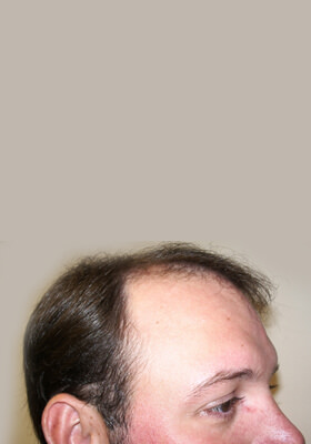 hair transplant before after Photos