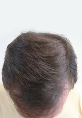 hair transplant photos