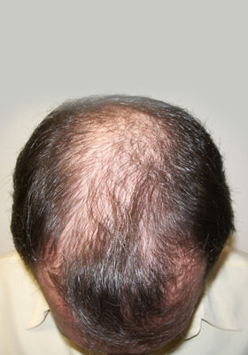 hair transplant photos