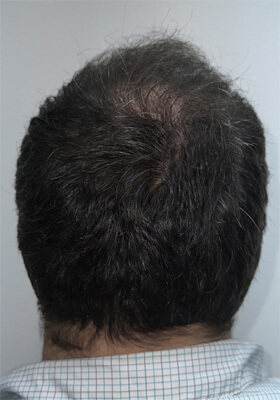 hair transplant before after Photos