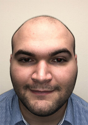 hair transplant before after Photos