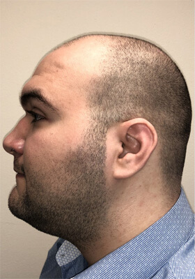 hair transplant before after Photos