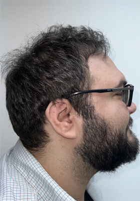 hair transplant before after Photos