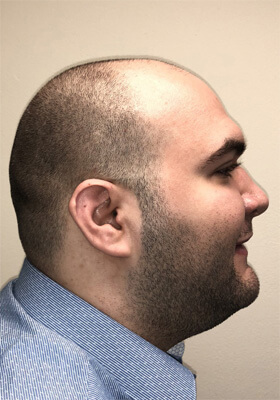 hair transplant before after Photos