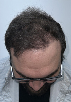 hair transplant photos