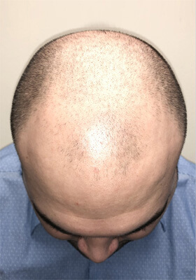 hair transplant before after Photos
