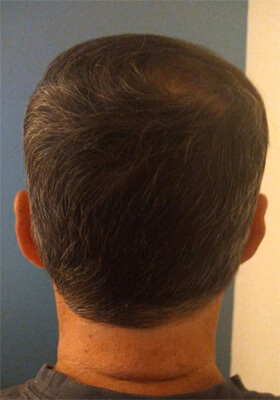 hair transplant photos