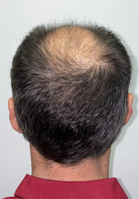 hair transplant photos