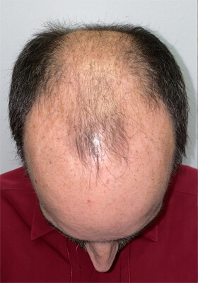 hair transplant photos