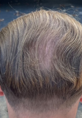 hair transplant photos