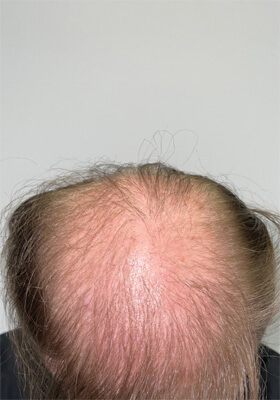 hair transplant photos