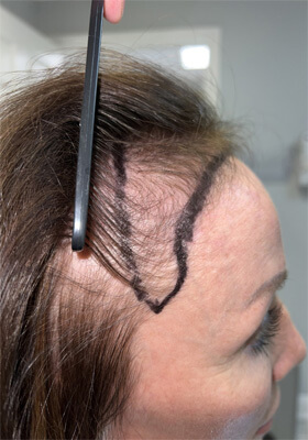 hair transplant photos