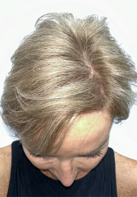 hair transplant photos