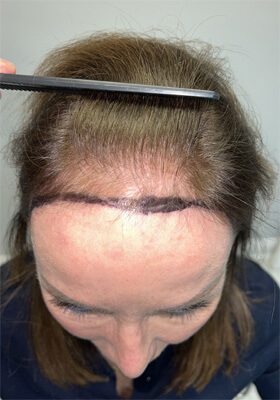 hair transplant photos