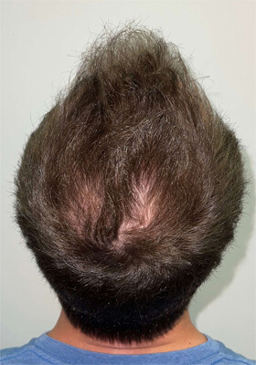 hair transplant before after Photos