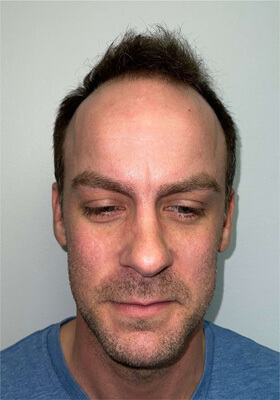 hair transplant before after Photos