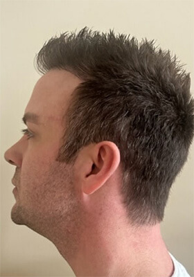 hair transplant before after Photos