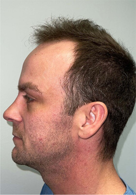 hair transplant before after Photos