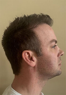 hair transplant photos