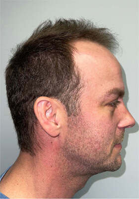 hair transplant before after Photos