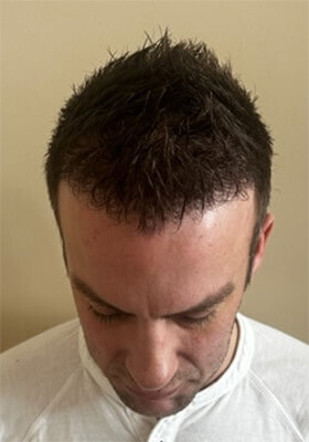 hair transplant before after Photos