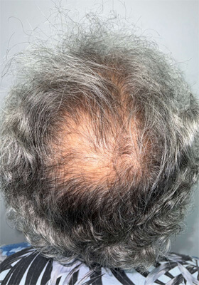 hair transplant photos