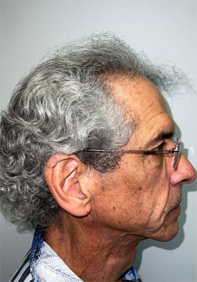 hair transplant before after Photos