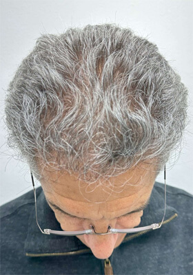 hair transplant photos