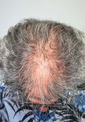 hair transplant photos