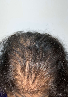 hair transplant photos