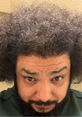 hair transplant before after Photos