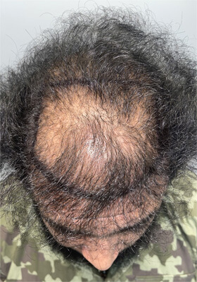 hair transplant photos