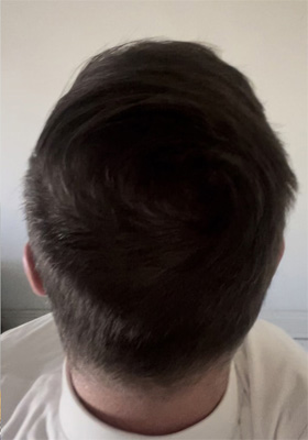 hair transplant photos