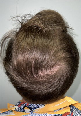 hair transplant photos