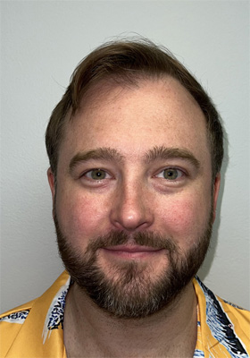 hair transplant photos