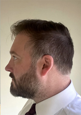 hair transplant before after Photos