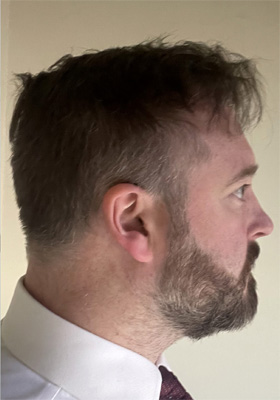 hair transplant photos