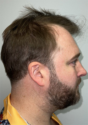 hair transplant before after Photos