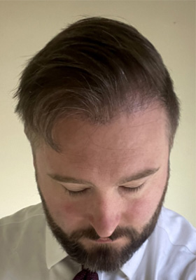 hair transplant before after Photos