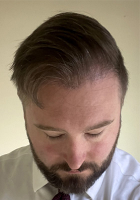 hair transplant photos