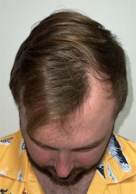 hair transplant before after Photos