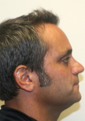 hair transplant before after Photos