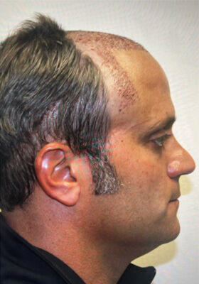 hair transplant photos