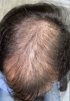 hair transplant before after Photos