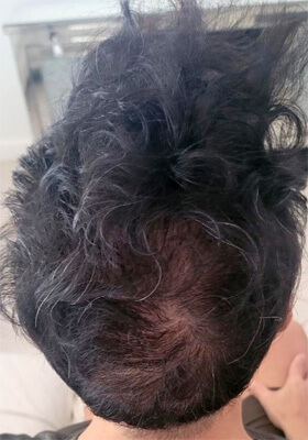 hair transplant photos