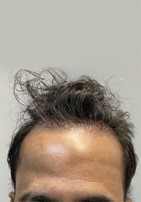 hair transplant before after Photos