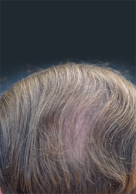 hair transplant photos