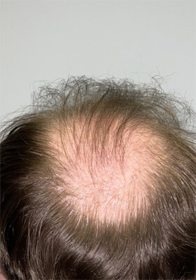 hair transplant before after Photos