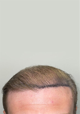 hair transplant before after Photos